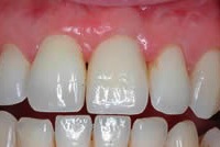 dental implant after placement